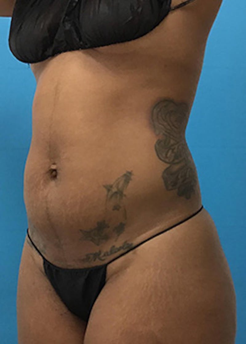 Liposuction Before & After Gallery - Patient 147702771 - Image 13