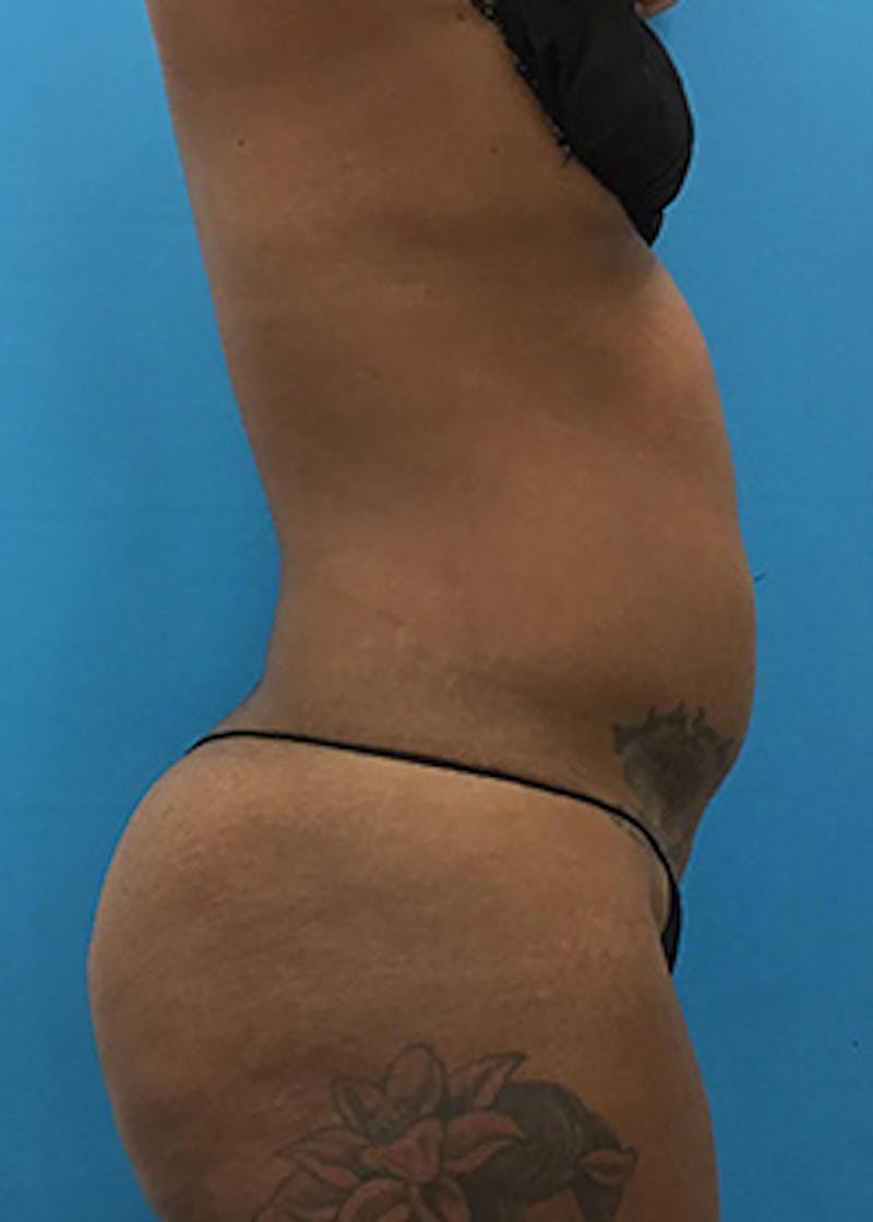 Liposuction Before & After Gallery - Patient 147702771 - Image 5