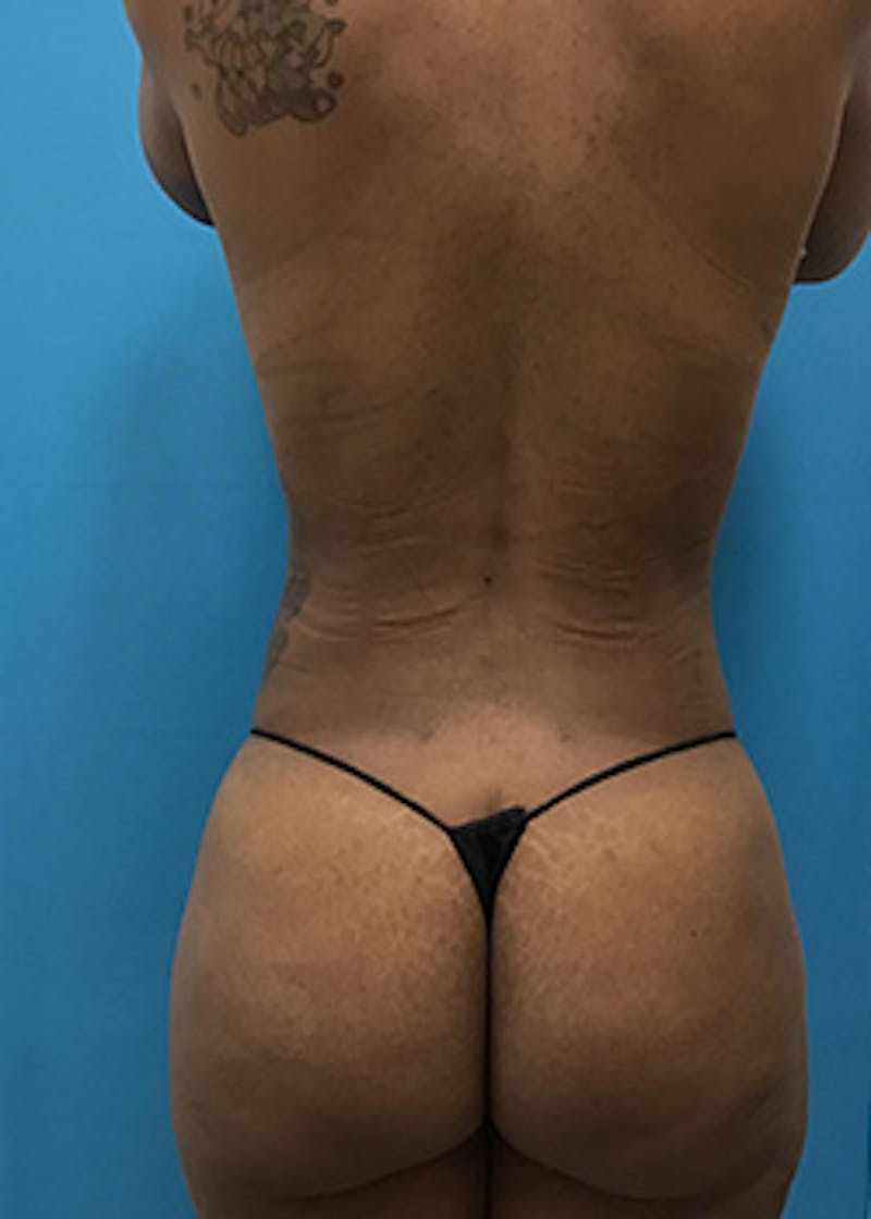 Liposuction Before & After Gallery - Patient 147702771 - Image 10