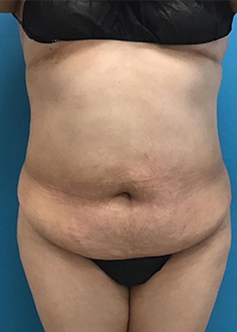 Tummy Tuck Before & After Gallery - Patient 147702781 - Image 1