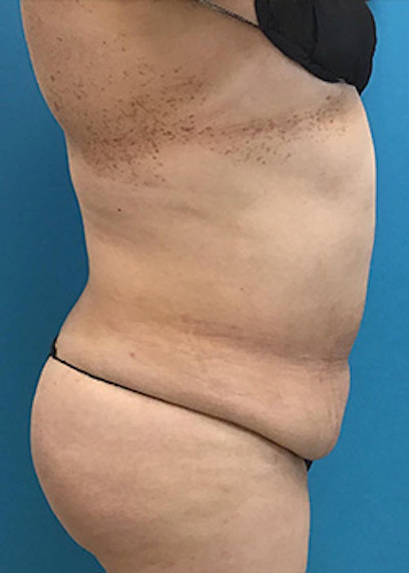 Tummy Tuck Before & After Gallery - Patient 147702781 - Image 3