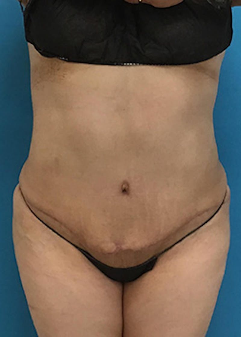 Liposuction Before & After Gallery - Patient 147702780 - Image 2