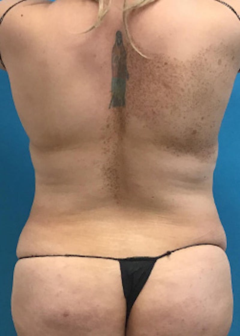 Tummy Tuck Before & After Gallery - Patient 147702781 - Image 7