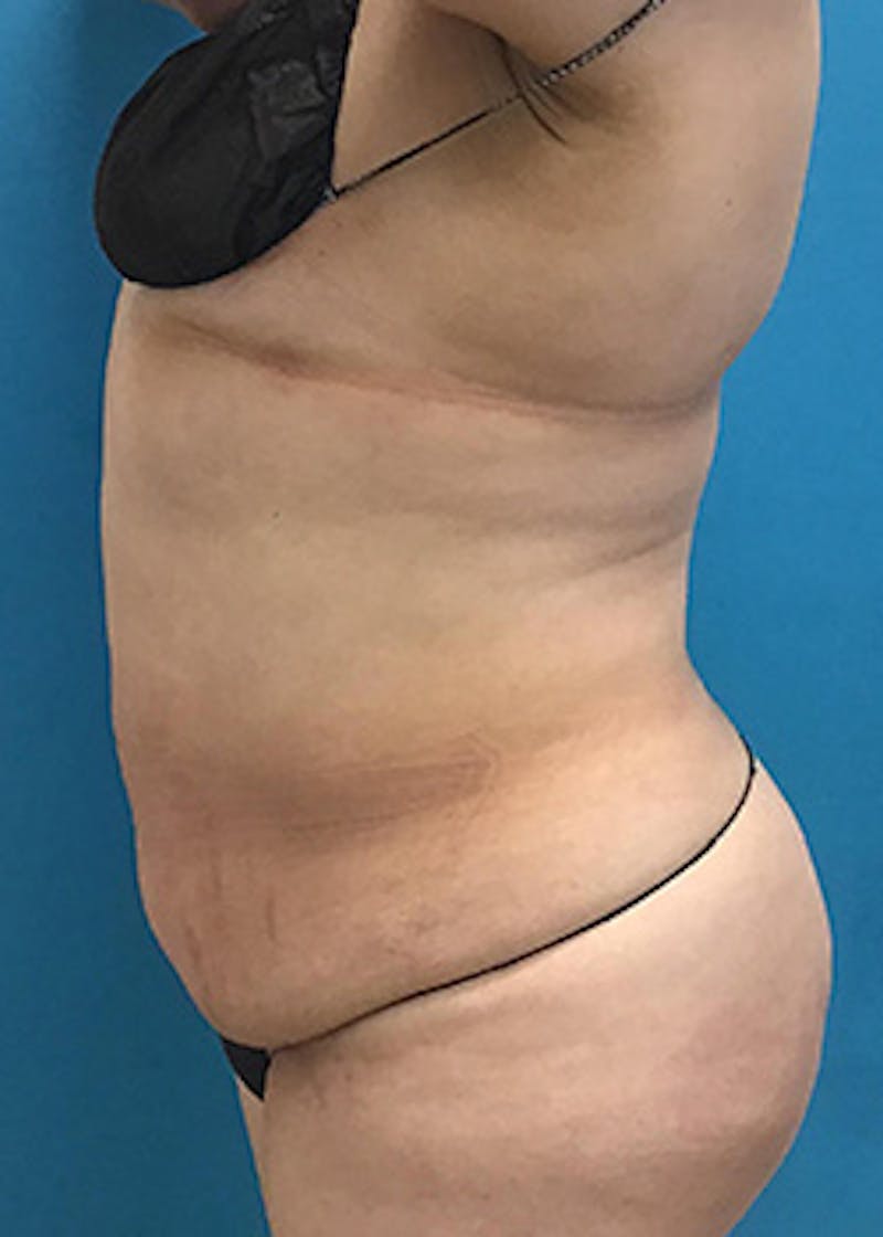 Liposuction Before & After Gallery - Patient 147702780 - Image 5