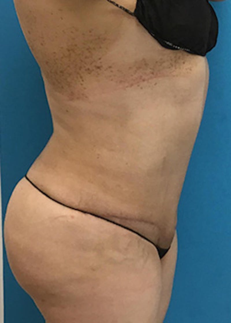 Liposuction Before & After Gallery - Patient 147702780 - Image 4