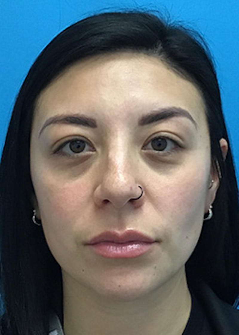 Fillers Before & After Gallery - Patient 147702782 - Image 1