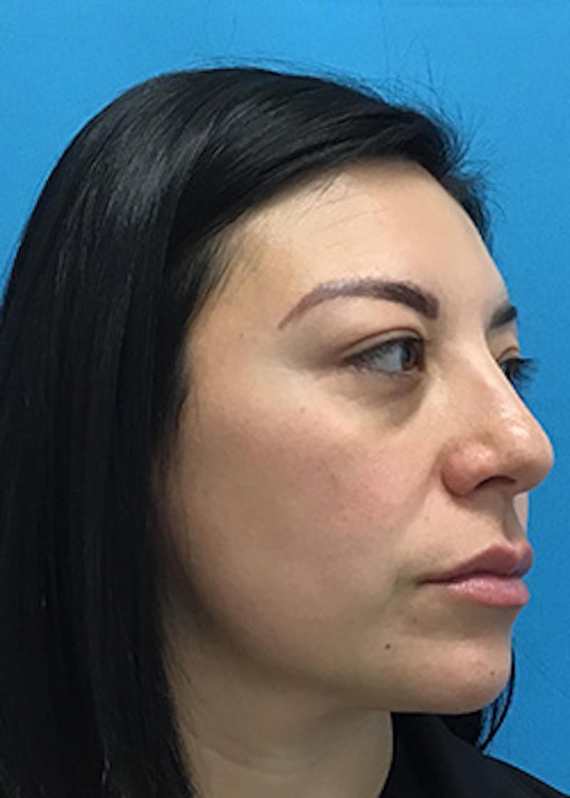 Fillers Before & After Gallery - Patient 147702782 - Image 3