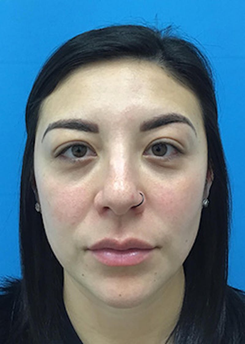 Fillers Before & After Gallery - Patient 147702782 - Image 2