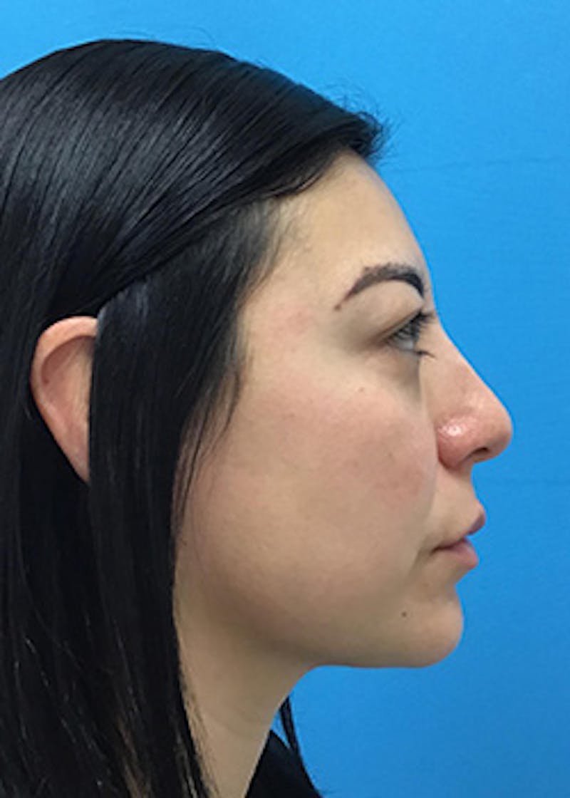 Fillers Before & After Gallery - Patient 147702782 - Image 6