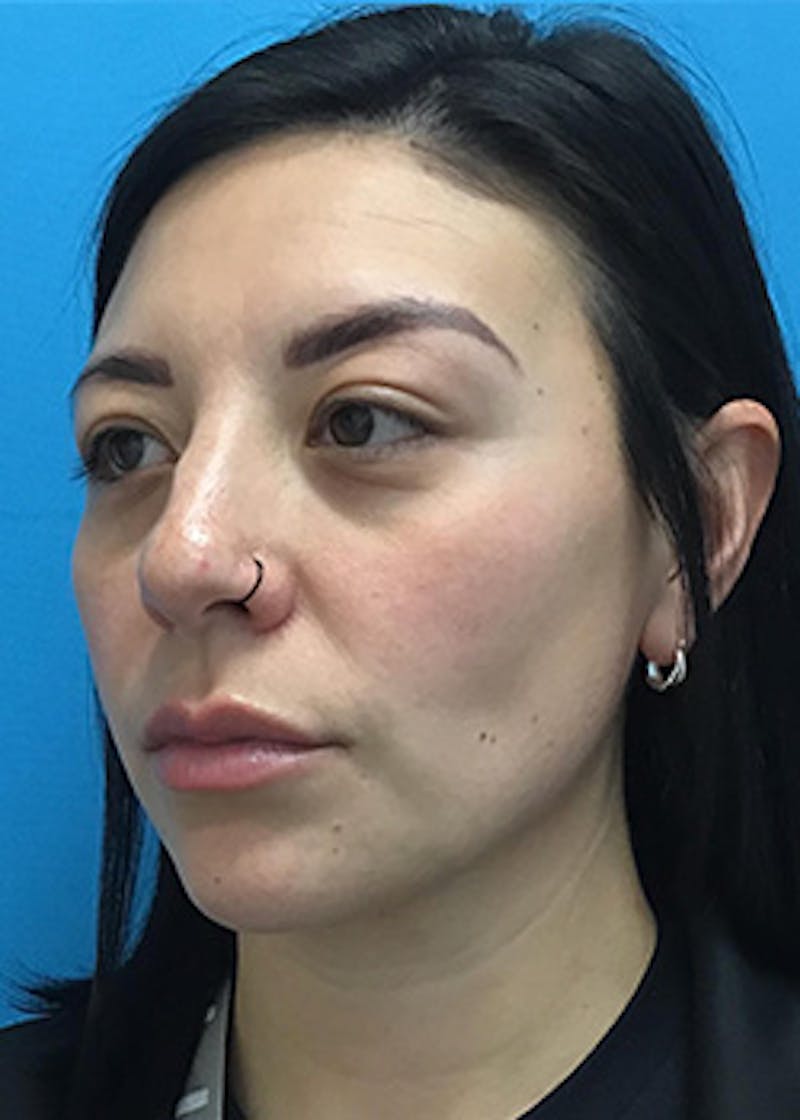 Fillers Before & After Gallery - Patient 147702782 - Image 7