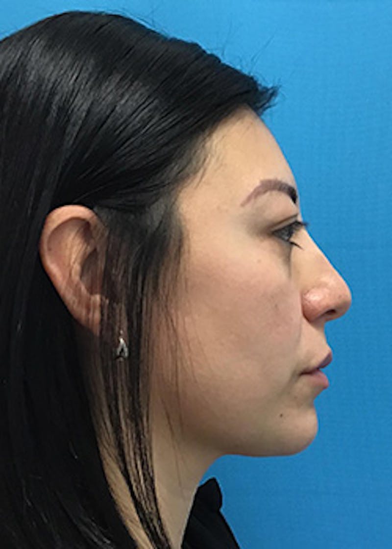 Fillers Before & After Gallery - Patient 147702782 - Image 5