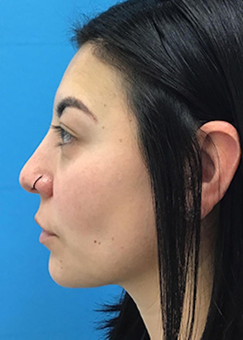 Fillers Before & After Gallery - Patient 147702782 - Image 10