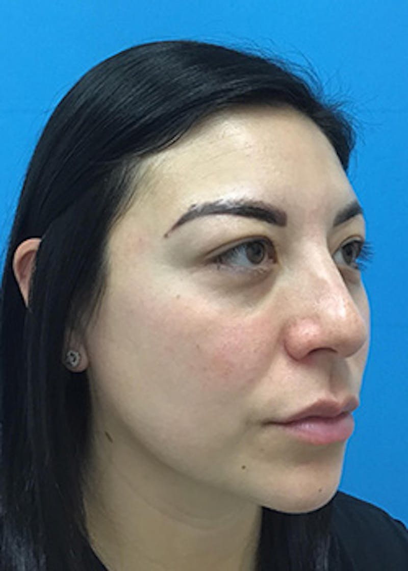 Fillers Before & After Gallery - Patient 147702782 - Image 4