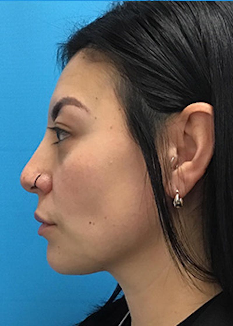 Fillers Before & After Gallery - Patient 147702782 - Image 9