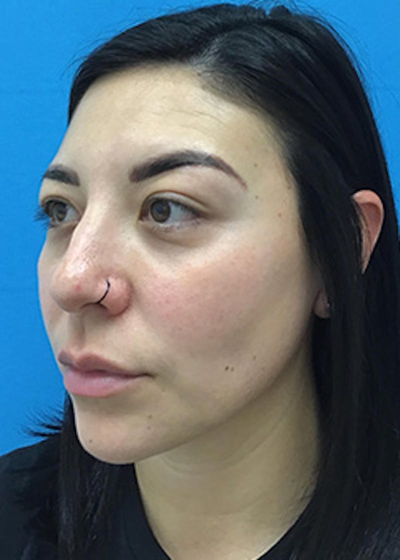 Fillers Before & After Gallery - Patient 147702782 - Image 8