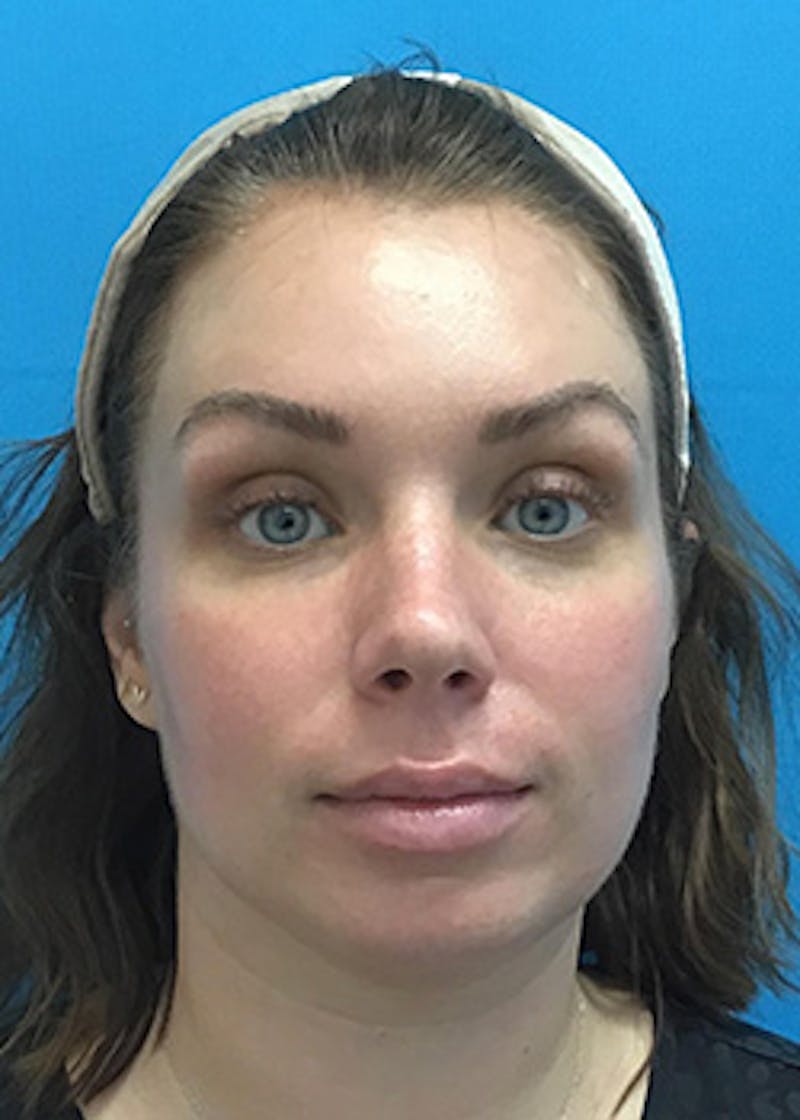 Fillers Before & After Gallery - Patient 147702786 - Image 1