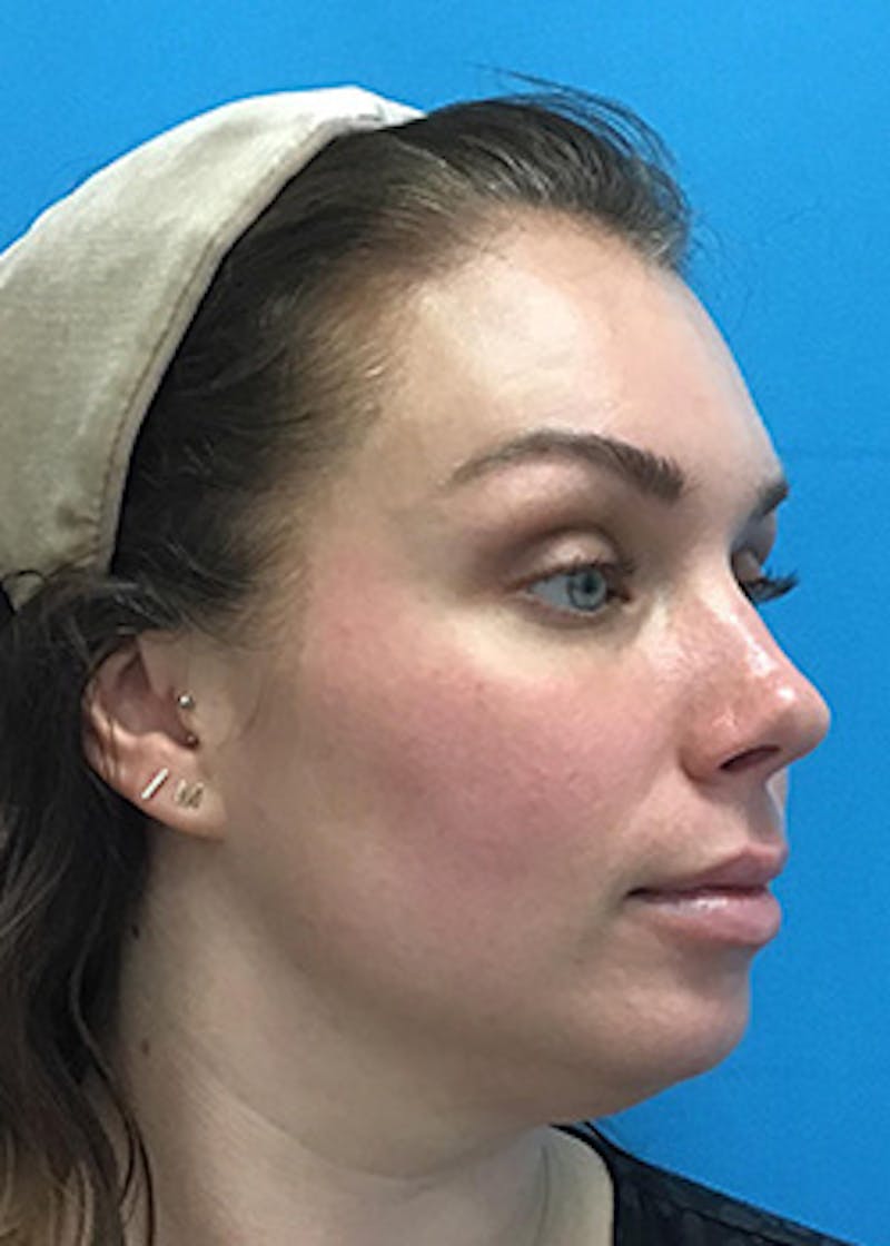Fillers Before & After Gallery - Patient 147702786 - Image 3