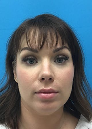 Fillers Before & After Gallery - Patient 147702786 - Image 2