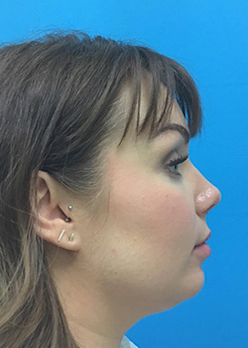 Fillers Before & After Gallery - Patient 147702786 - Image 6