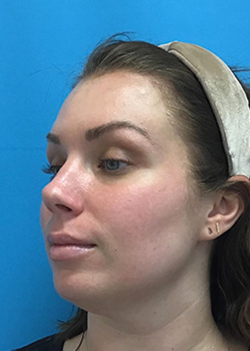 Fillers Before & After Gallery - Patient 147702786 - Image 7