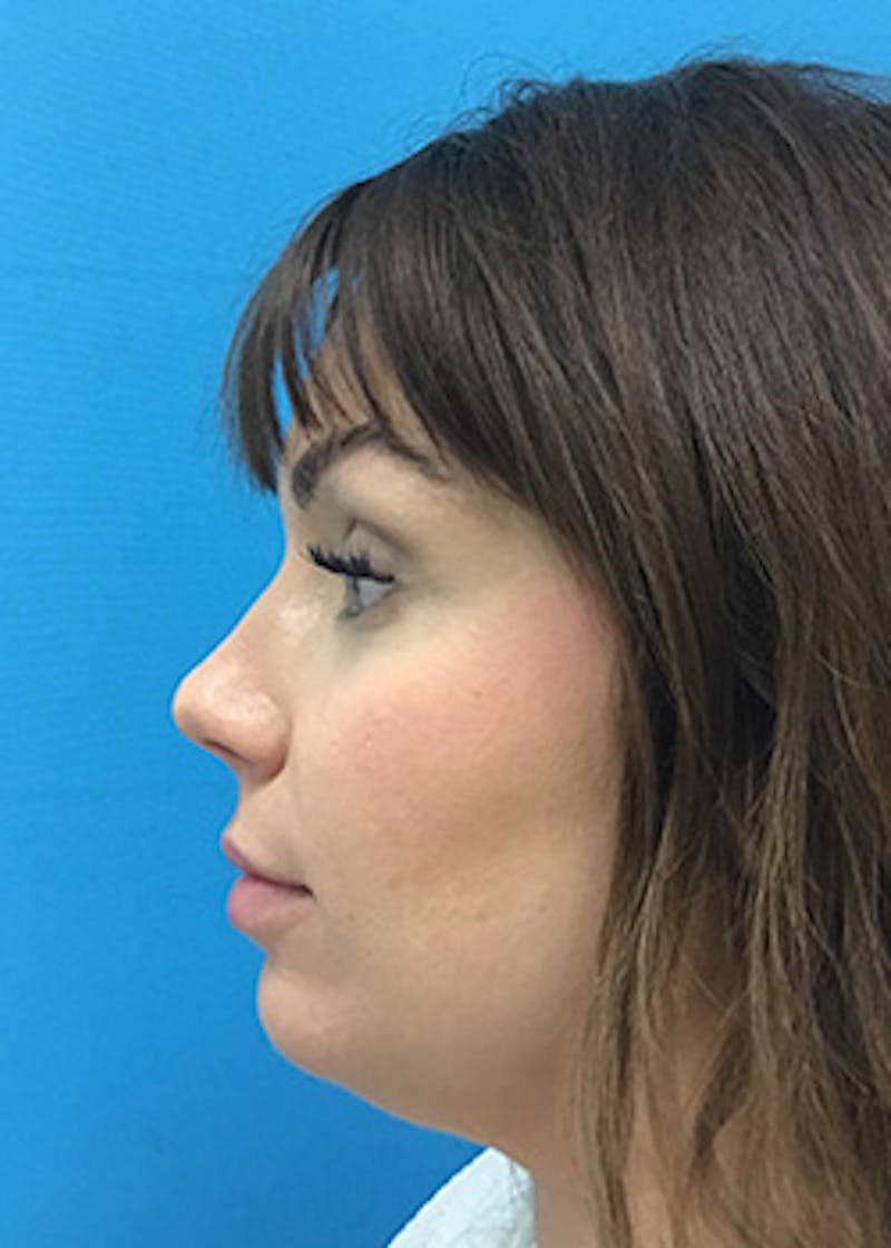Fillers Before & After Gallery - Patient 147702786 - Image 10