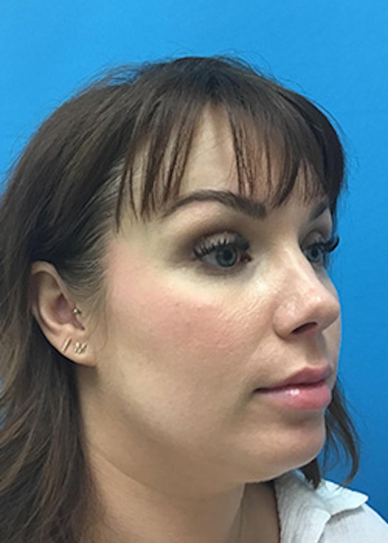 Fillers Before & After Gallery - Patient 147702786 - Image 4