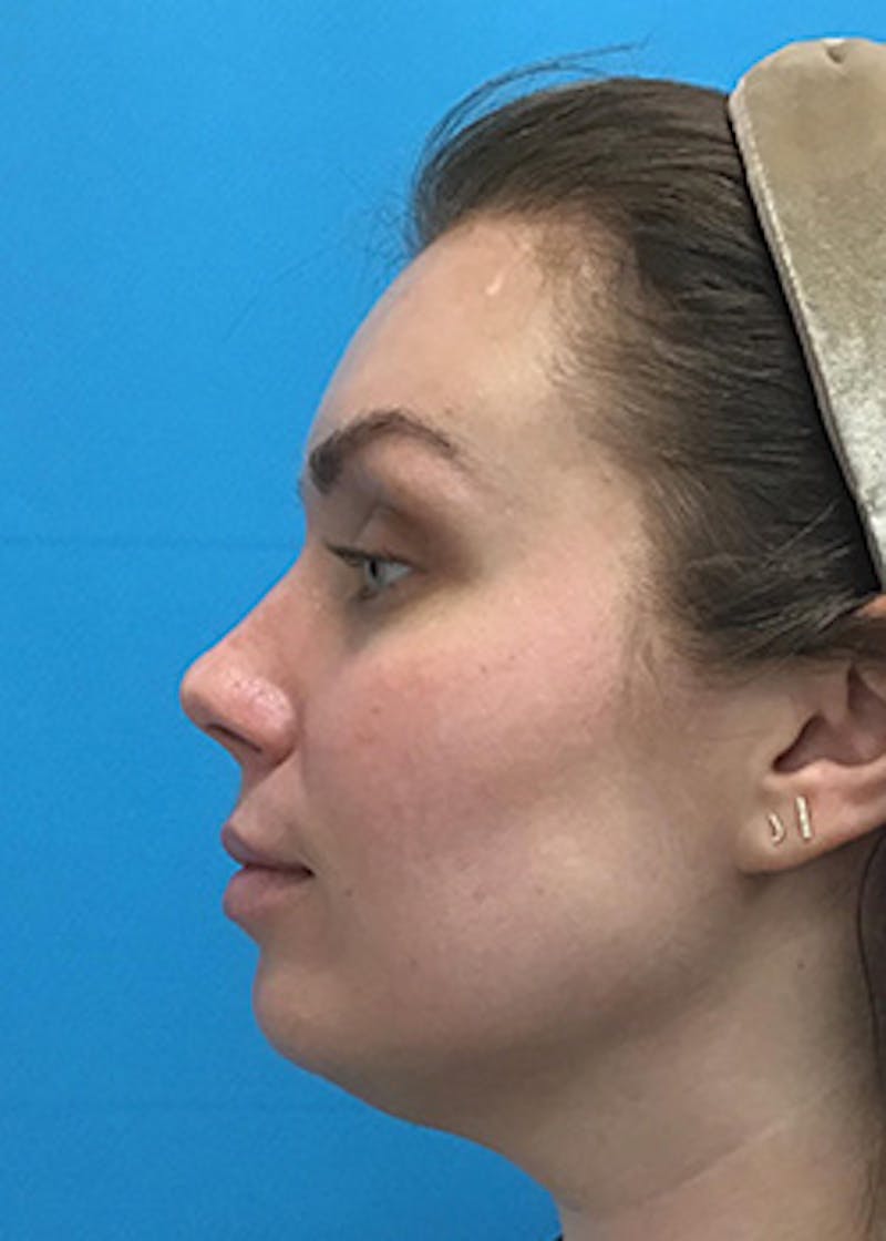 Fillers Before & After Gallery - Patient 147702786 - Image 9