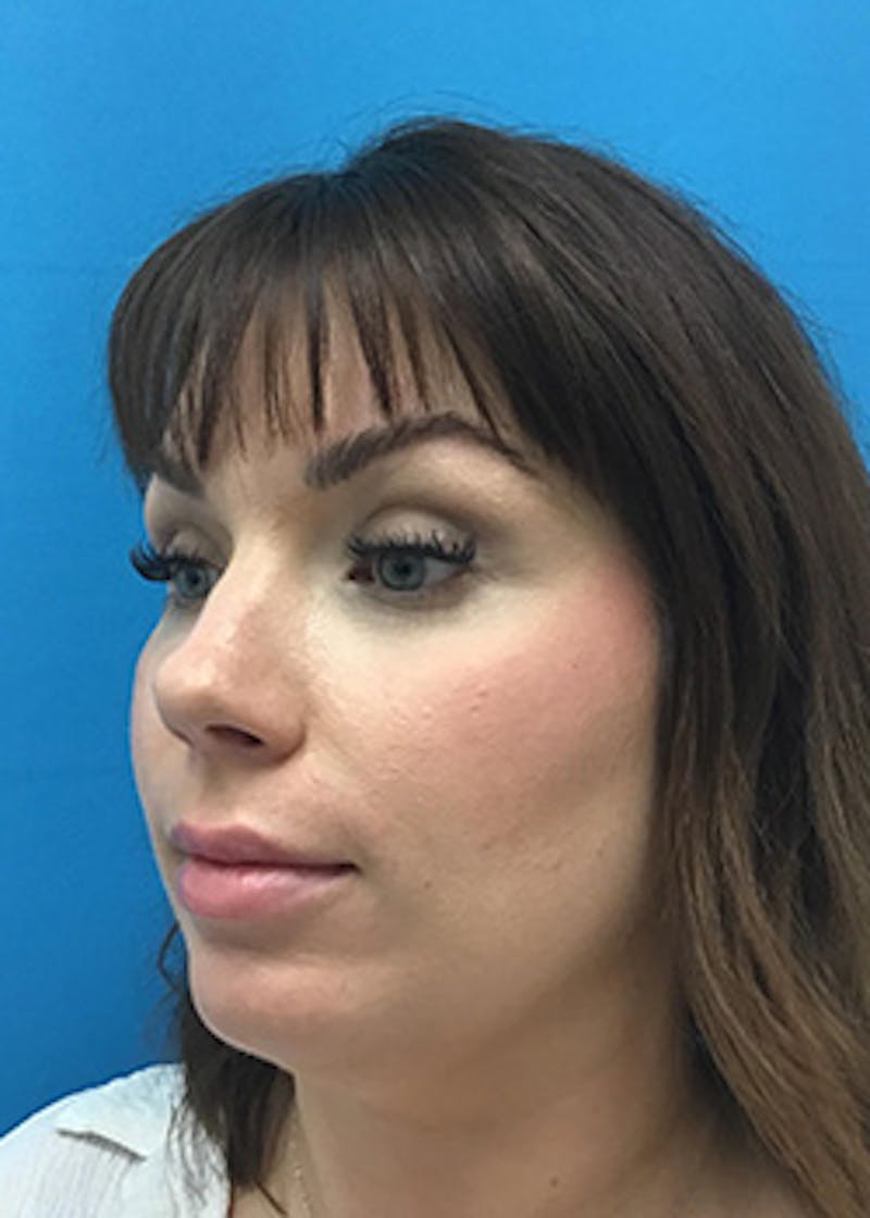 Fillers Before & After Gallery - Patient 147702786 - Image 8