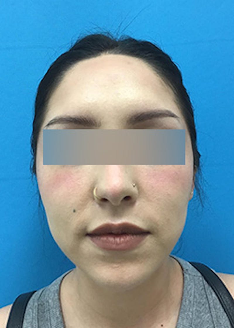 Fillers Before & After Gallery - Patient 147702792 - Image 1