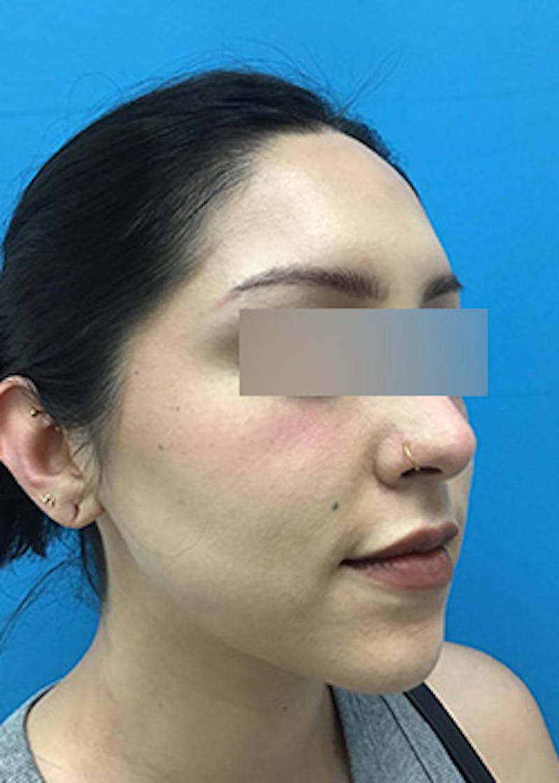 Fillers Before & After Gallery - Patient 147702792 - Image 3