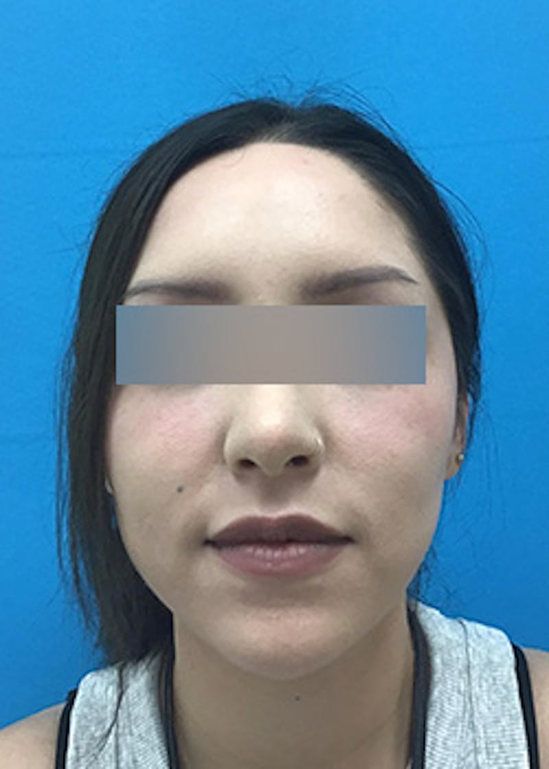 Fillers Before & After Gallery - Patient 147702792 - Image 2