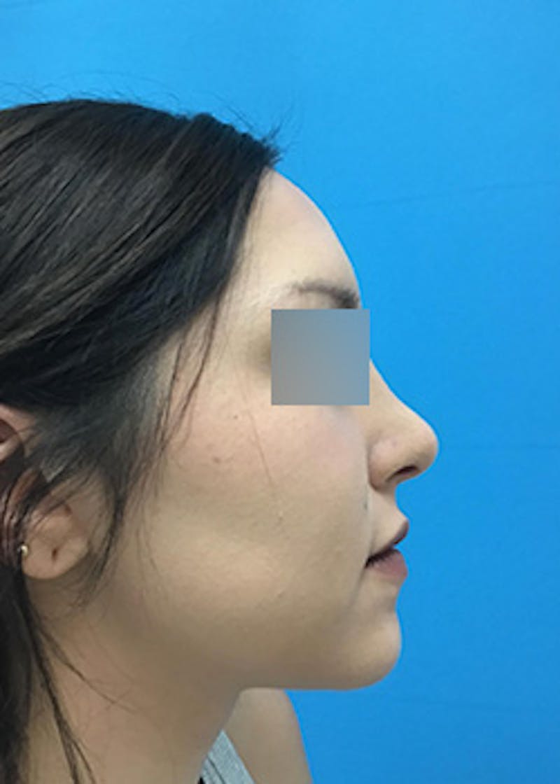 Fillers Before & After Gallery - Patient 147702792 - Image 6
