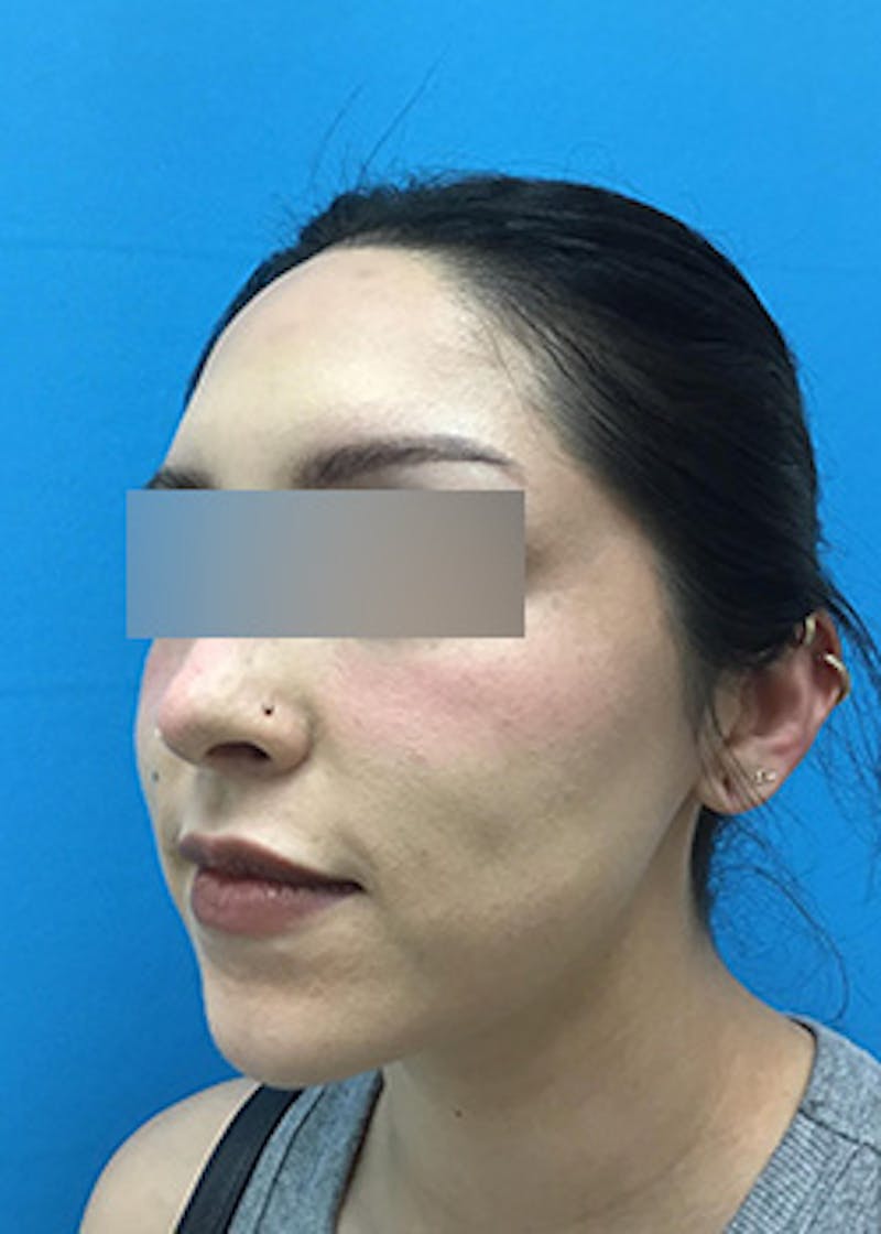 Fillers Before & After Gallery - Patient 147702792 - Image 7