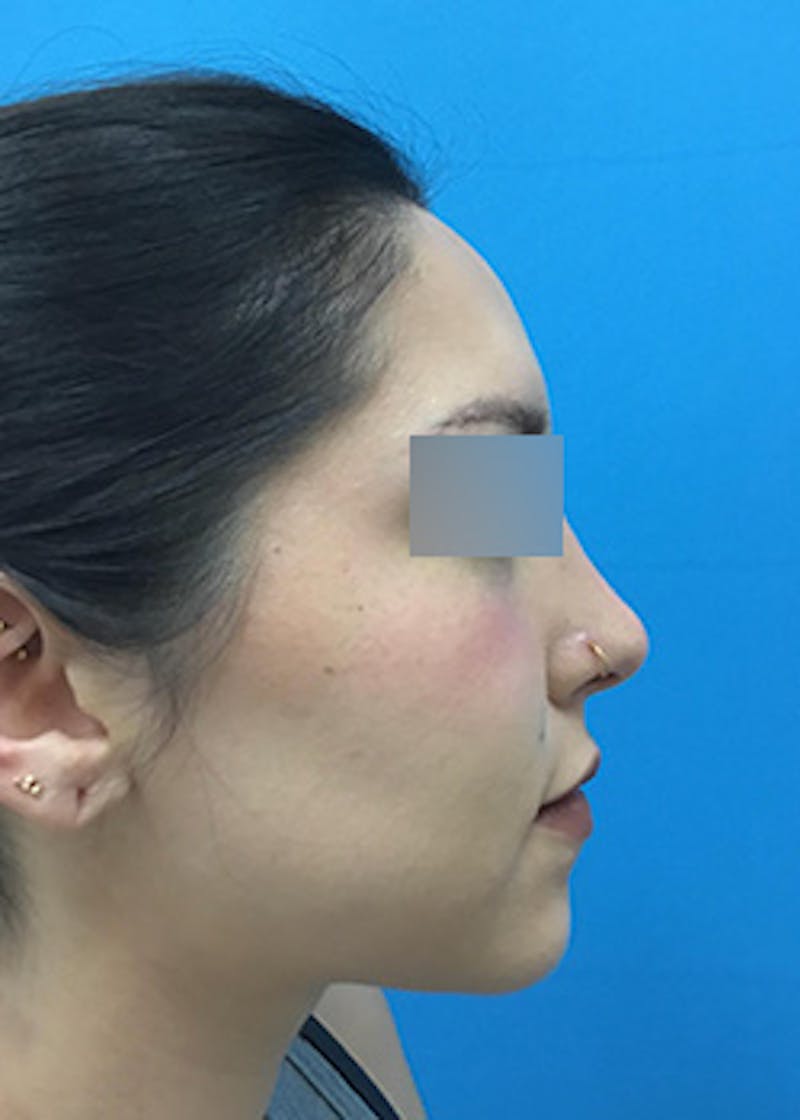 Fillers Before & After Gallery - Patient 147702792 - Image 5