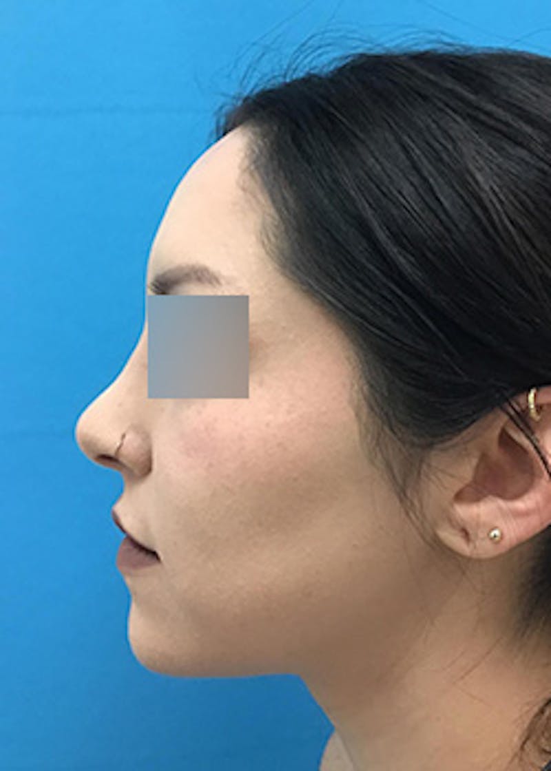 Fillers Before & After Gallery - Patient 147702792 - Image 10