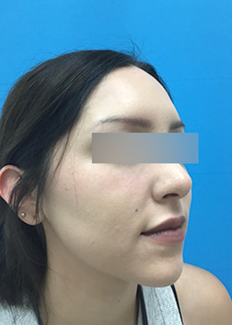 Fillers Before & After Gallery - Patient 147702792 - Image 4