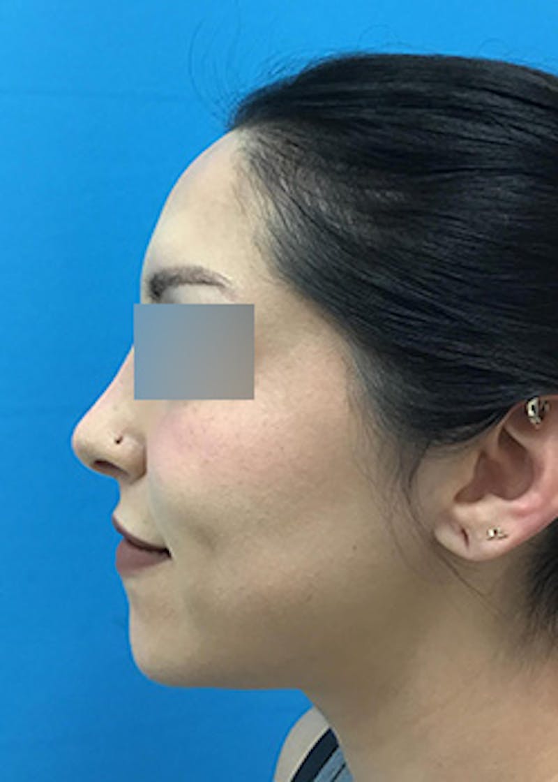 Fillers Before & After Gallery - Patient 147702792 - Image 9