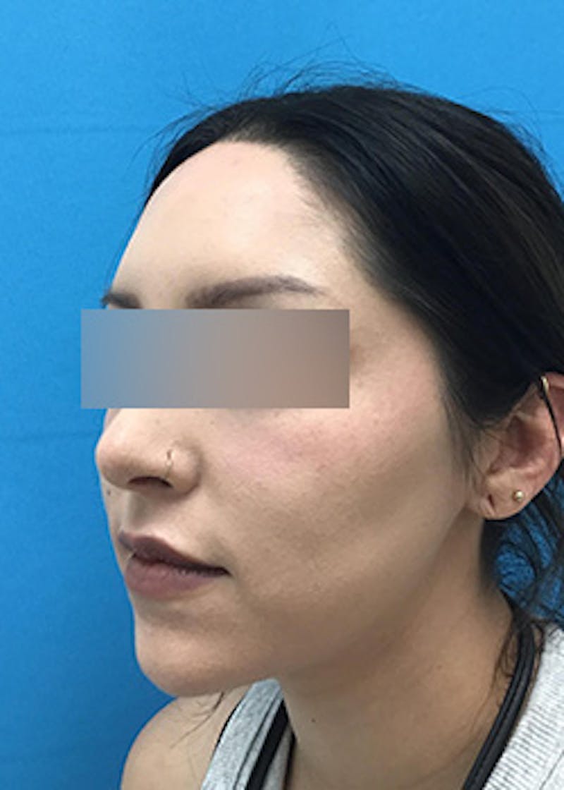 Fillers Before & After Gallery - Patient 147702792 - Image 8