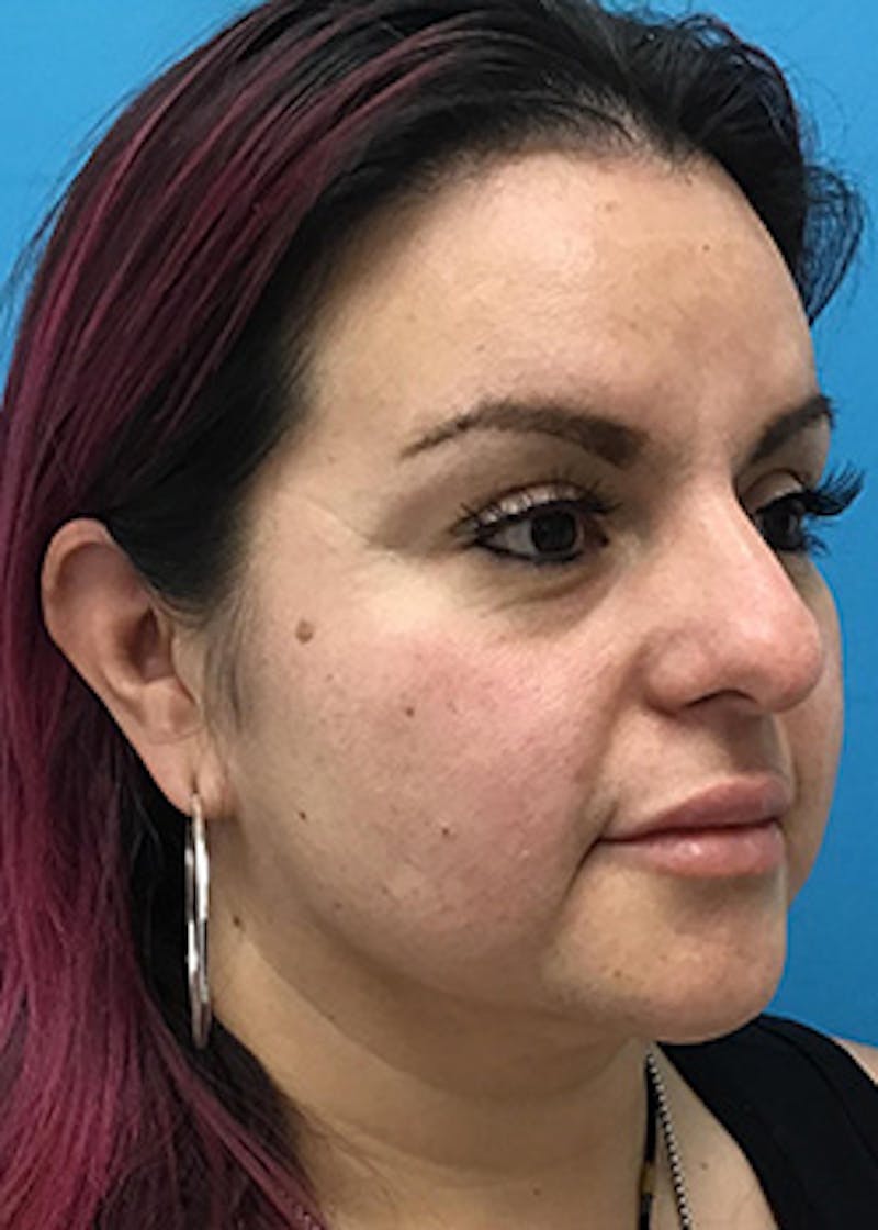 Fillers Before & After Gallery - Patient 147702796 - Image 3