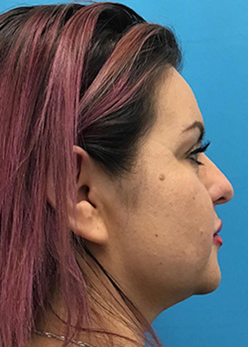 Fillers Before & After Gallery - Patient 147702796 - Image 6