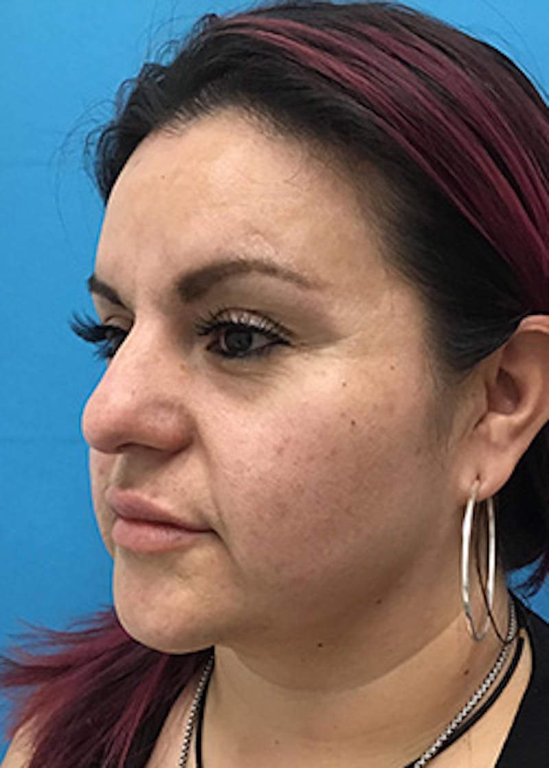 Fillers Before & After Gallery - Patient 147702796 - Image 7