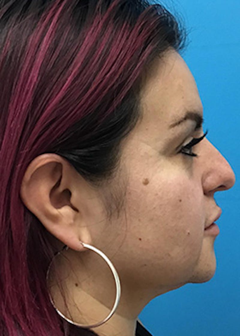 Fillers Before & After Gallery - Patient 147702796 - Image 5