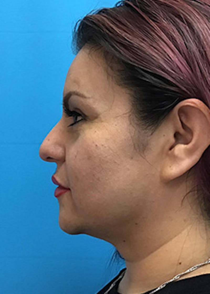 Fillers Before & After Gallery - Patient 147702796 - Image 10
