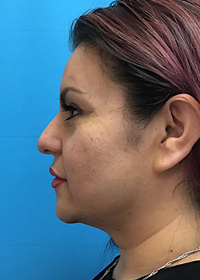 Fillers Before & After Gallery - Patient 147702796 - Image 10
