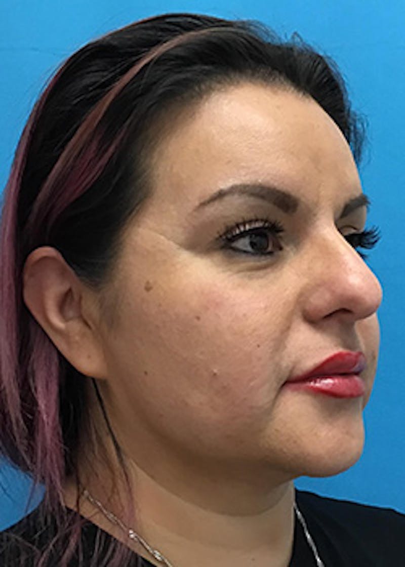 Fillers Before & After Gallery - Patient 147702796 - Image 4