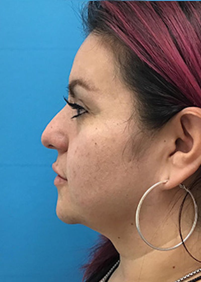 Fillers Before & After Gallery - Patient 147702796 - Image 9