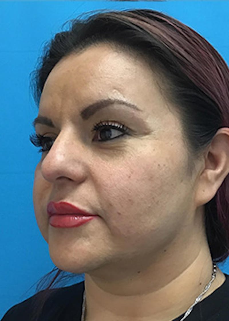 Fillers Before & After Gallery - Patient 147702796 - Image 8