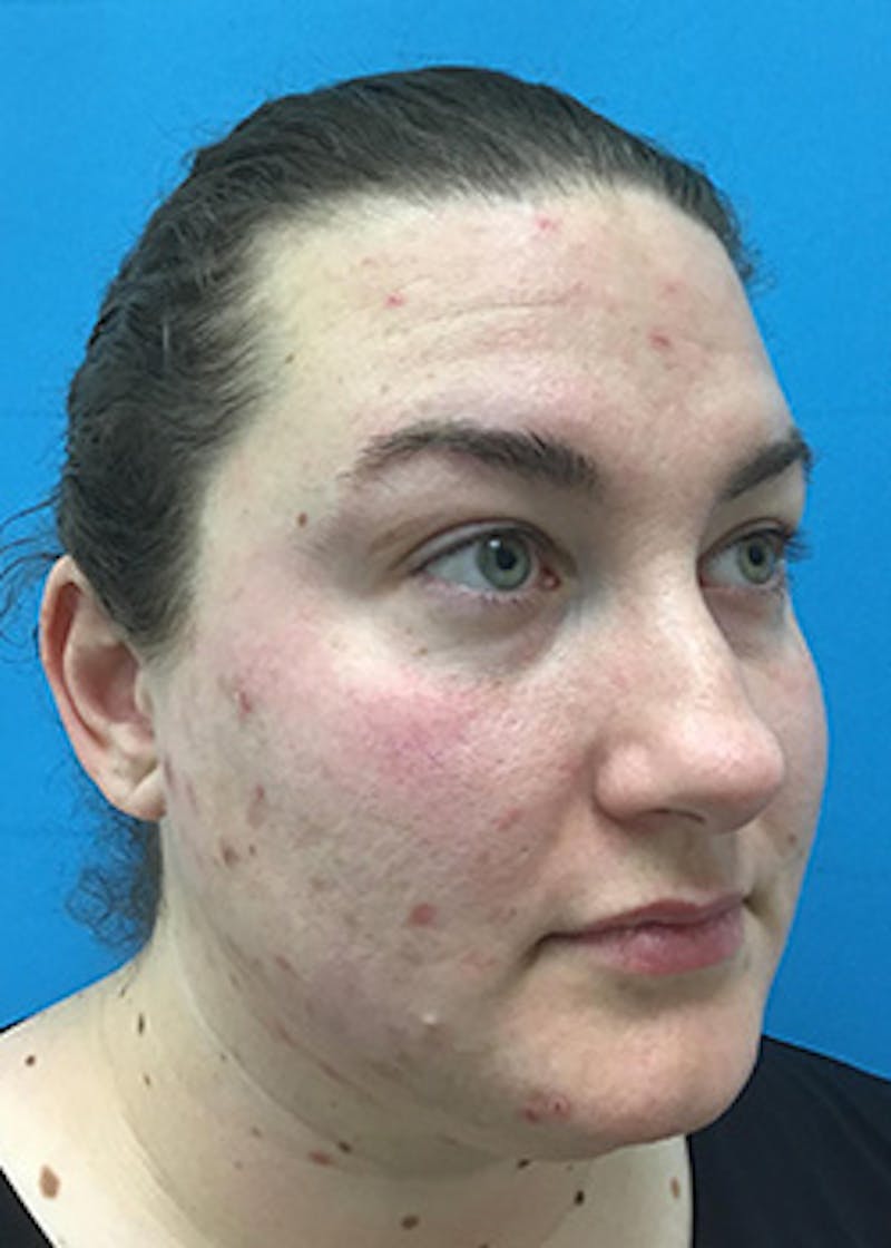 Fillers Before & After Gallery - Patient 147702798 - Image 3