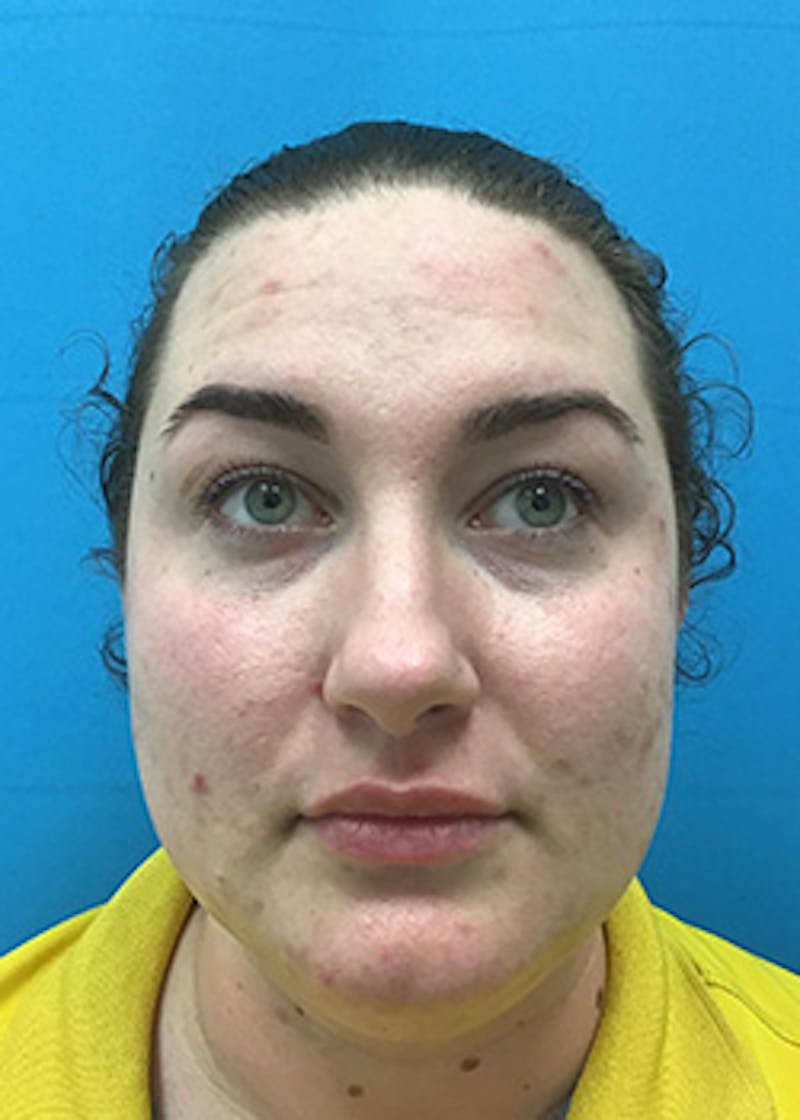 Fillers Before & After Gallery - Patient 147702798 - Image 2