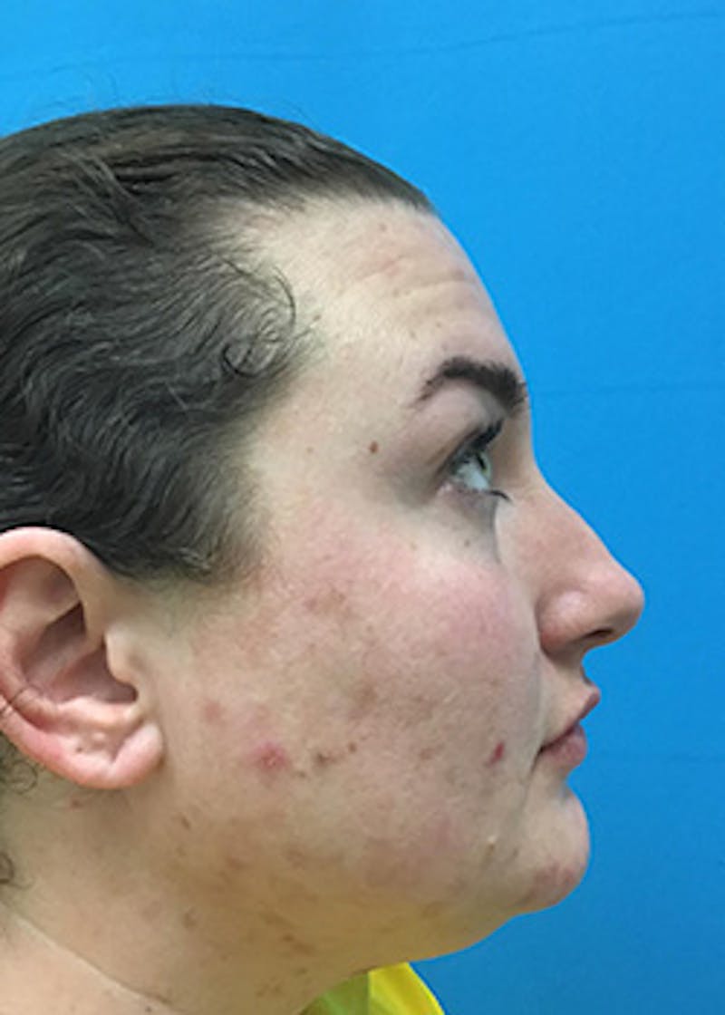 Fillers Before & After Gallery - Patient 147702798 - Image 6